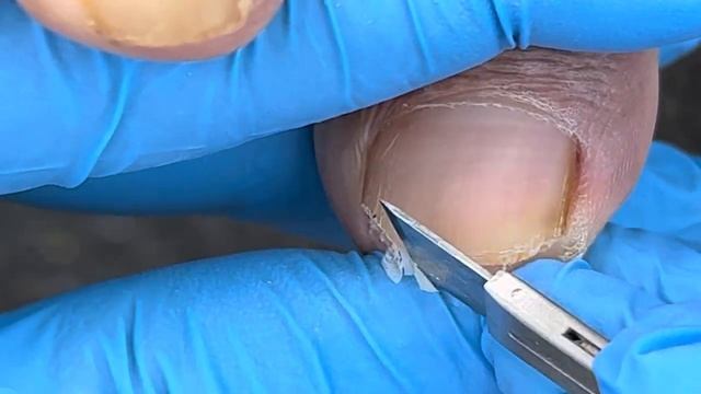 Thick and long ingrown toenail, bad nail removal【Xue Yidao Pedicure】 смотреть онлайн