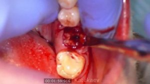 Удаление первого моляра