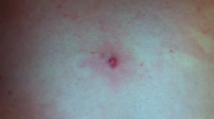 Как выдавить жировик