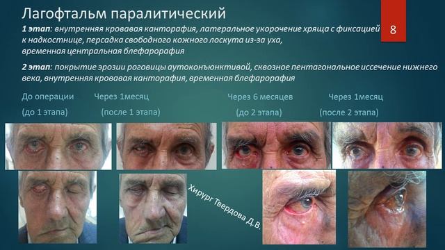 Офтальмопластическая хирургия. Твердова Диана Валерьевна, Краснодар, Россия.