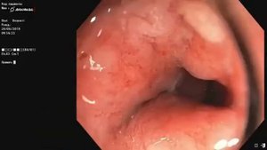 Язвенный колит, Колоноскопия.