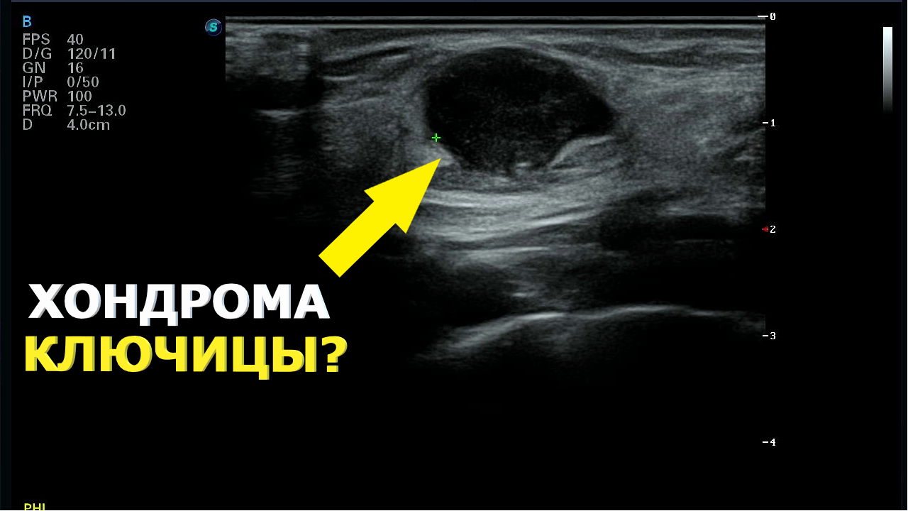 Образования ключицы на УЗИ смотреть онлайн