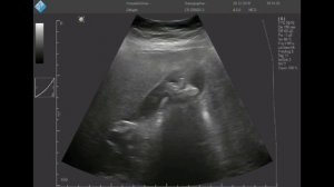 Конкременты желчного пузыря (мобильное УЗИ)