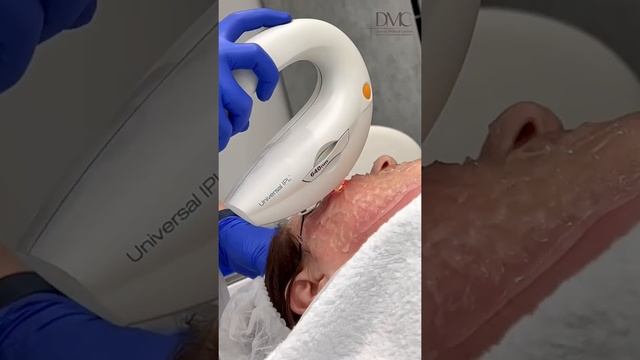 Лазерное омоложение на аппарате М22. Как проходит процедура лазерного омоложения на аппарате  М22. смотреть онлайн