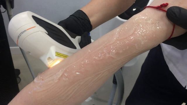 Фотоэпиляция смотреть онлайн