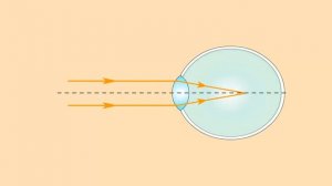 119 - 8кл - Коррекция близорукости