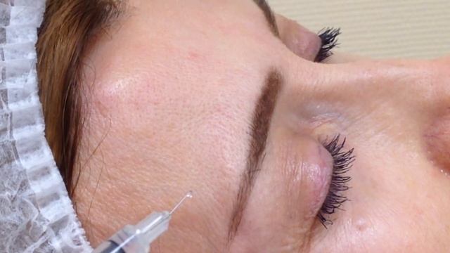 Аирисокм студенты учатся: семинар по введению ботокса - лоб, межбровье, круговая мышца глаза смотреть онлайн