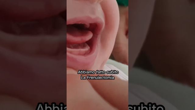 Prima e Dopo l’INTERVENTO di FRENULECTOMIA LINGUALE DEL NEONATO - FRENULO LINGUALE CORTO смотреть онлайн