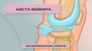 Киста Бейкера