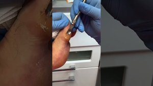 Работа скальпелем | обработка колпачком