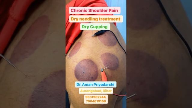 Physiotherapy || dry needling || dry cupping || shoulder injury || pain relief ||