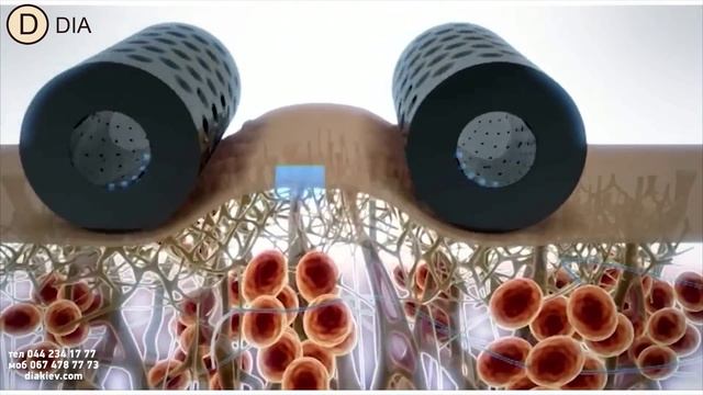 Массаж тела на аппарате ICOONE смотреть онлайн