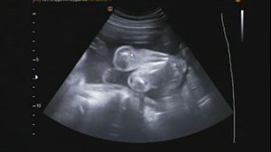 3Д узи на 25 неделе