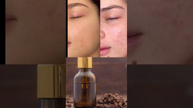 clove oil for acne