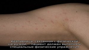Что такое физическая крапивница