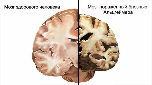 Болезнь Аьцгеймера, диагностика и лечение. Рассказывает математик Александр Петрович Кулешов. 2016.