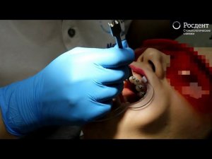 Процесс фиксации брекет-системы