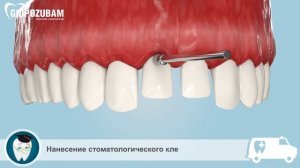 Виниры. Этапы установки виниров.