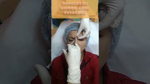 Ботокс лоб и межбровье. Колим и смотрим результат.