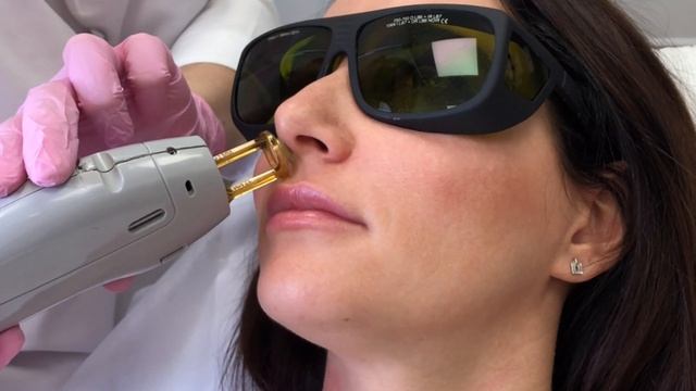 Лазерная эпиляция носа смотреть онлайн