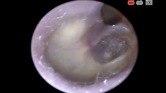 Эндоскопия уха - ХГСО, эпитимапнит смотреть онлайн
