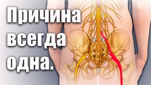 ИЗ ЗА этой причины у 90% людей зажат СЕДАЛИЩНЫЙ НЕРВ.