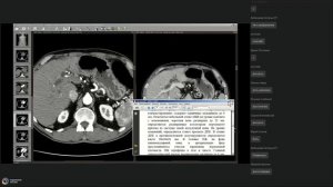 Техника написания заключений КТ Острый и хронический панкреатит   2 часть
