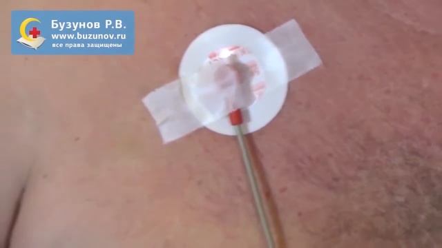 Как проводится полисомнография для диагностики обструктивного апноэ сна. Постановка датчиков