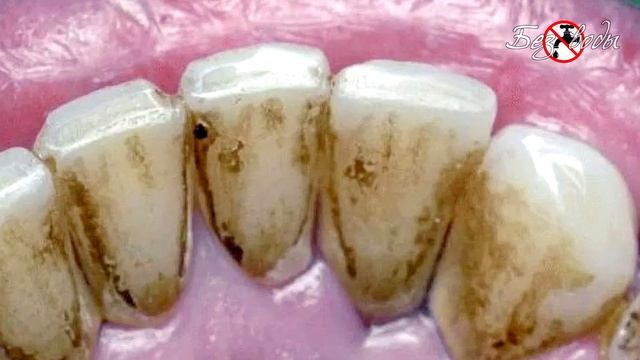 Пародонтоз, пародонтит не приговор. Вылечить можно специями которые стоят копейки.