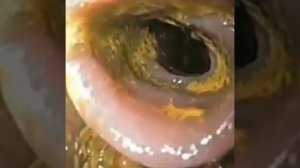 Кишечник здорового и нездорового человека - наглядный пример