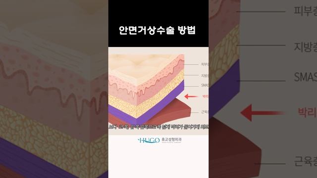 #안며거상술전후 #안면거상전후 #안면거상후 смотреть онлайн