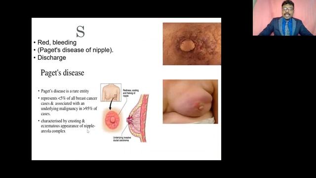 CLINICAL BREAST EXAMINATION/ BREAST CANCER SCREENING/ MALE & FEMALE BREAST CANCER/CANCER PREVENTION