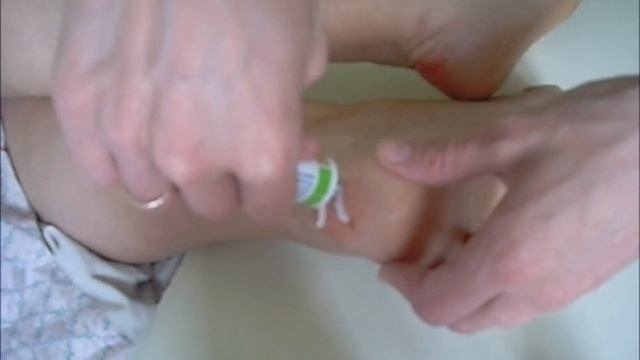 Чем лечить открытую мозоль