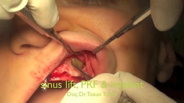 Sinus lifting, PRF & implant смотреть онлайн