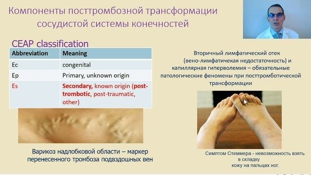 Болезни вен, часть 3.  Осложнения венозного тромбоза.  Лекция для студентов медуниверситета.