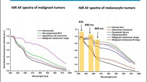 #452 Yulia Khristoforova The study of ex vivo and in vivo melanocytic skin neoplasms using near