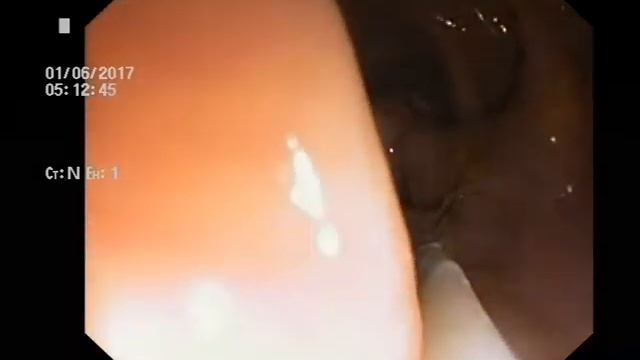 Удаление большого полипа толстой кишки смотреть онлайн