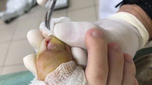 УДАЛЕНИЕ УГОЛКА НОГТЯ