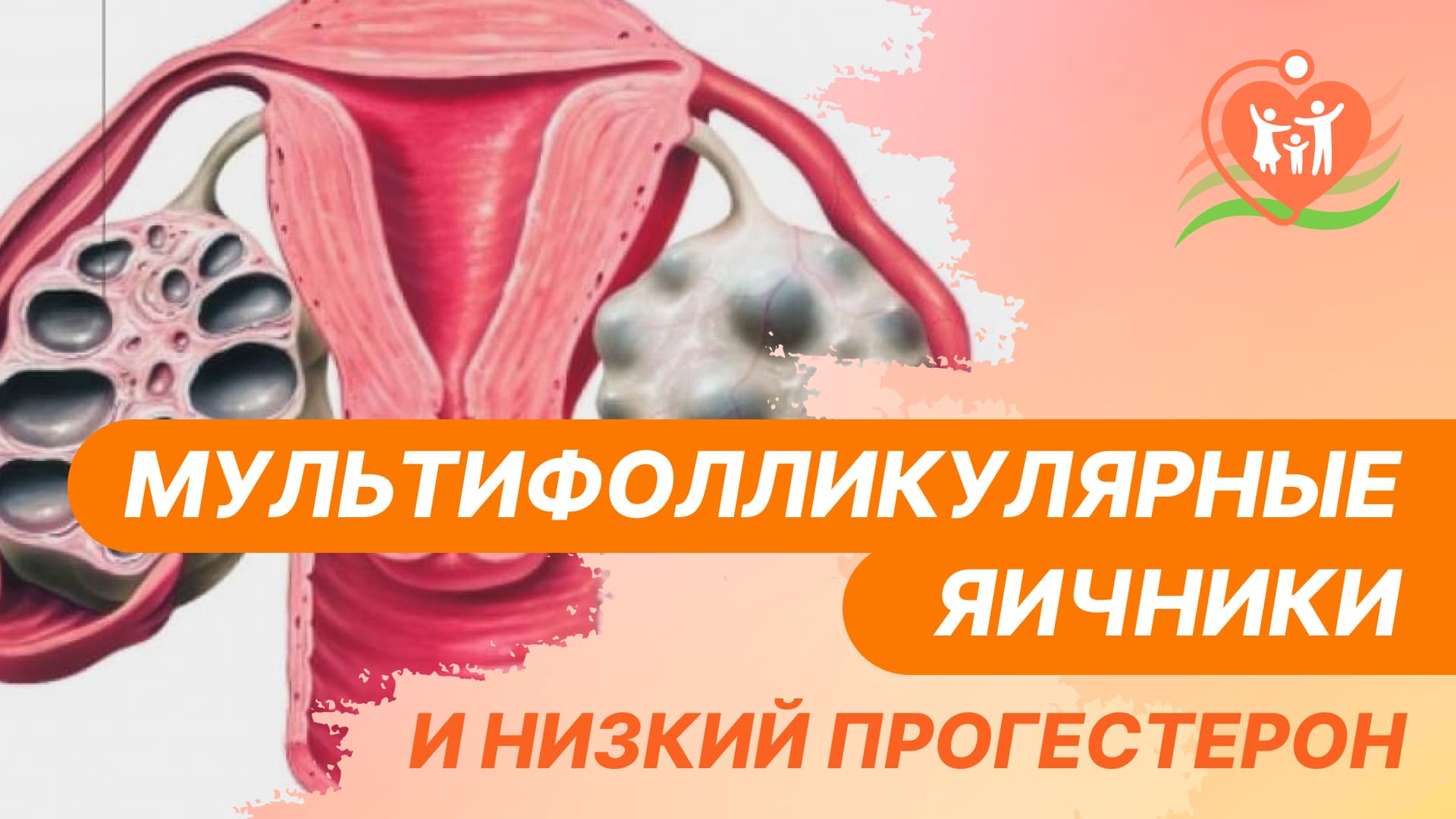 ? Мультифолликулярные яичники и низкий прогестерон