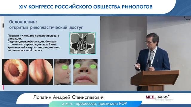 Новости о септопластике и хирургии перфорации перегородки носа