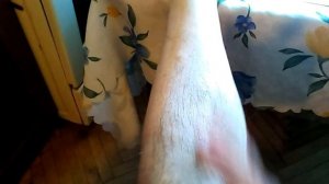 Мазь из каштанов при варикозе своими руками