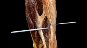 Подвздошно большеберцовый тракт Tractus iliotibialis