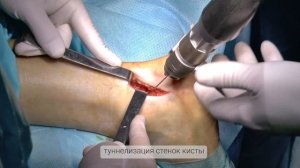 Костная пластика в области кисты таранной кости