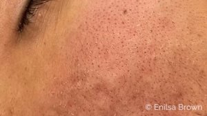 Blackhead & Whitehead Extractions on "K" Part 4