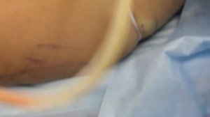 Лазерная липосакция в Дека Клинике Москва