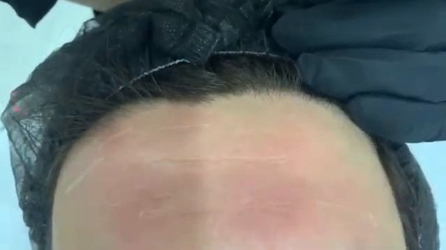 Комбинированная терапия отдельных видов морщин смотреть онлайн