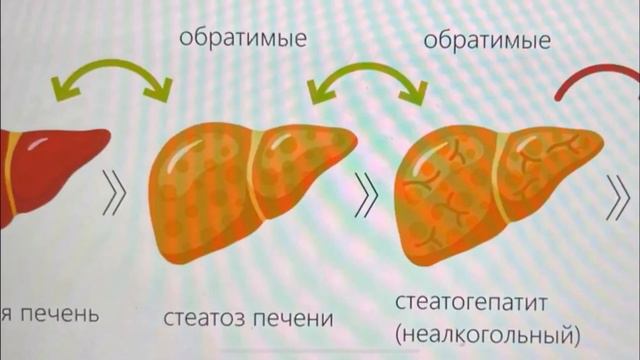 Цирроз печени. Бауыр циррозы. Қазақша видео. Механизм, патогенез, лечение, диагностика