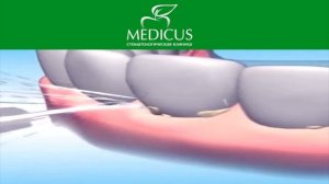 Как чистить зубы ирригатором?