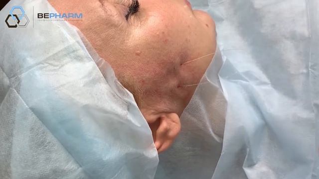 Мастер-класс имплантации армирующих нитей с насечками для коррекции средней трети лица.