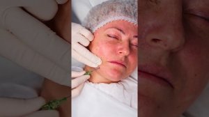 Мезонити «Кисти» одна из модификаций нитей-волюметриков для локальной коррекции объема мягких ткане